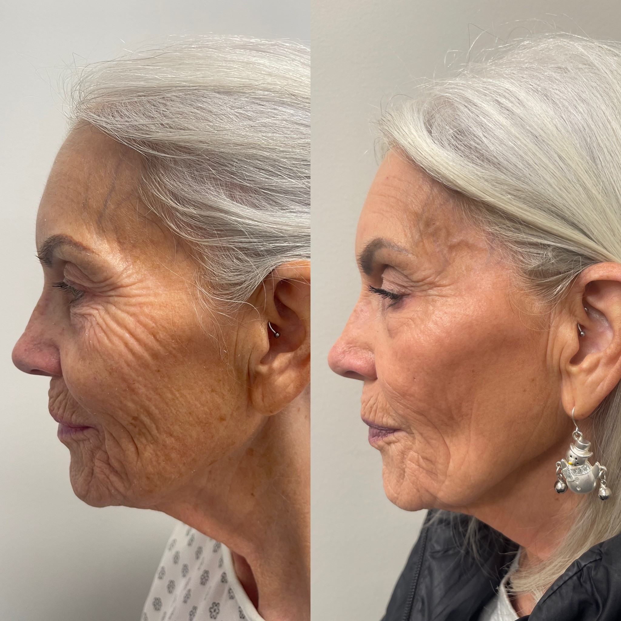 CO2 laser resurfacing for skin tightening and wrinkles
