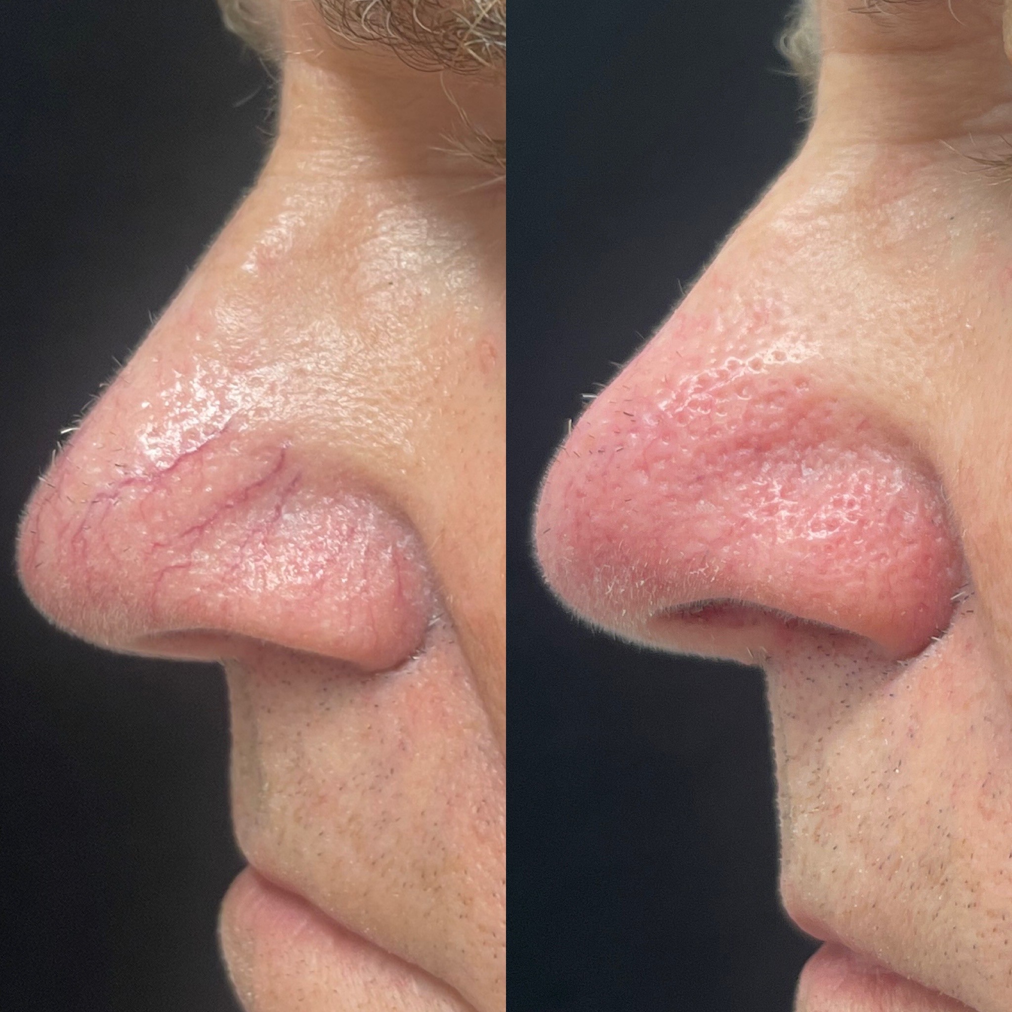 Before and After photo of laser treatment for broken blood vessels on nose (nasal telangiectasias_