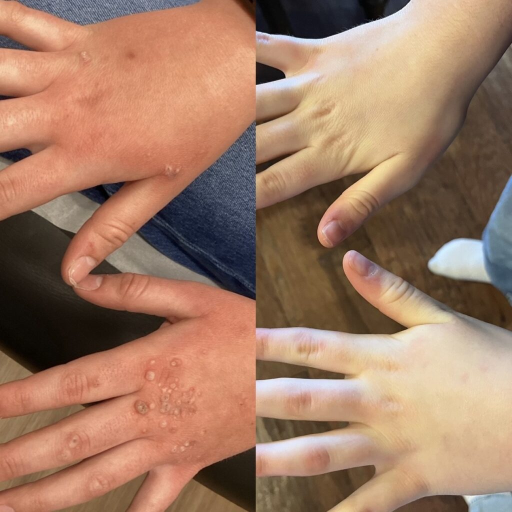 Before and after comparison of stubborn common warts on the hands treated with Swift microwave therapy by Dr. Matthew Innes in Layton, Utah
