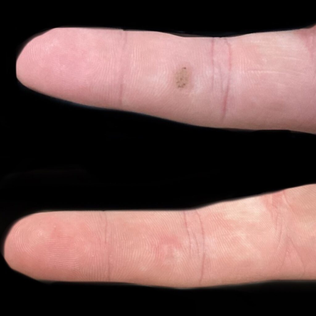 Common wart on the palmar surface of the finger showing complete clearance without scarring after Swift treatment