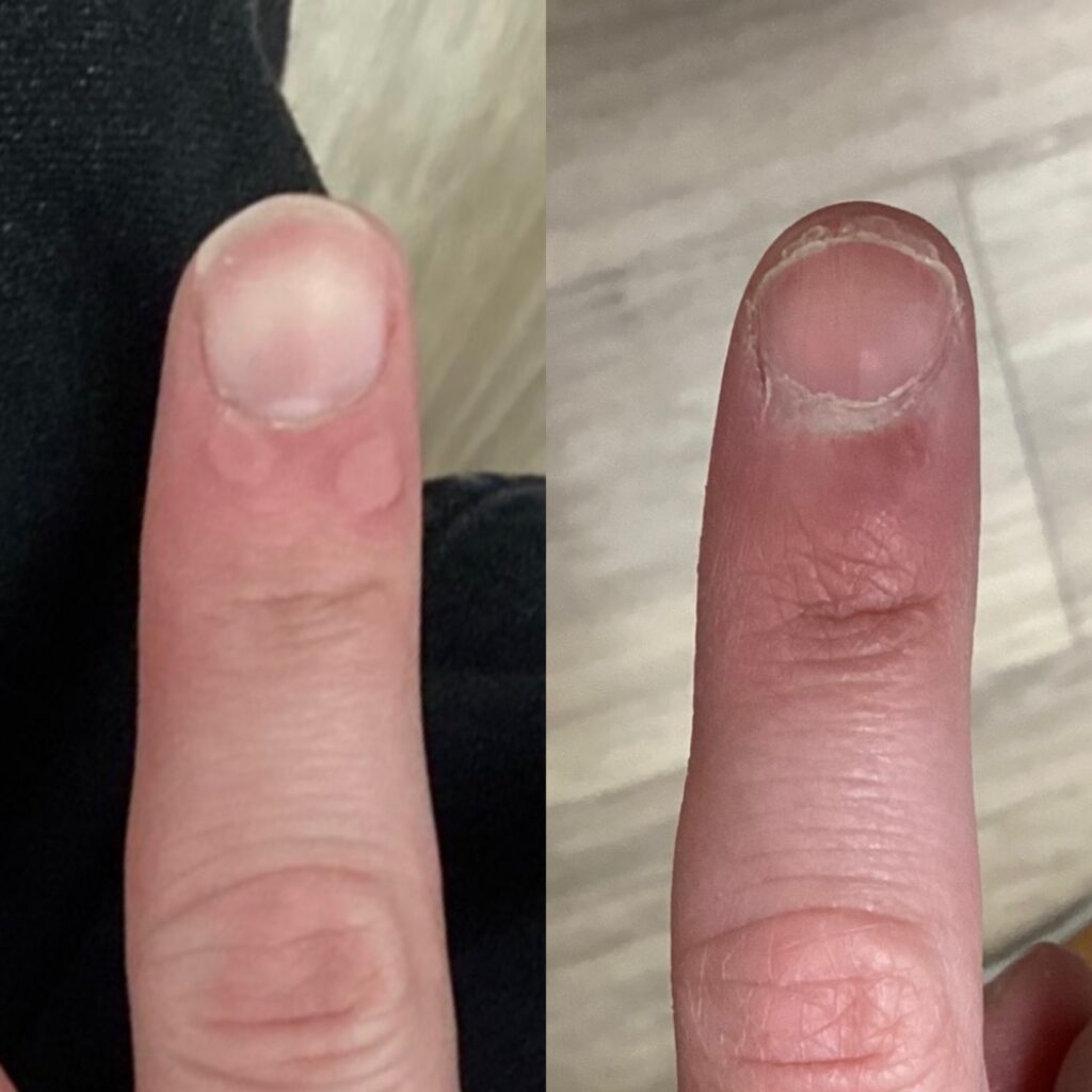 Periungual warts around the fingernail cuticle before treatment and showing full regrowth of healthy skin after Swift