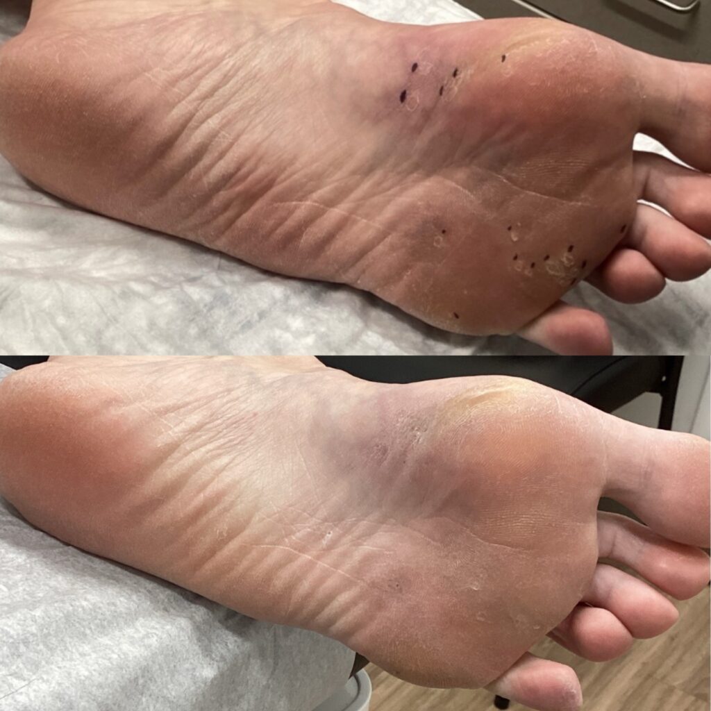 Before and after comparison of deep plantar warts on the sole of the foot, fully cleared after Swift microwave therapy