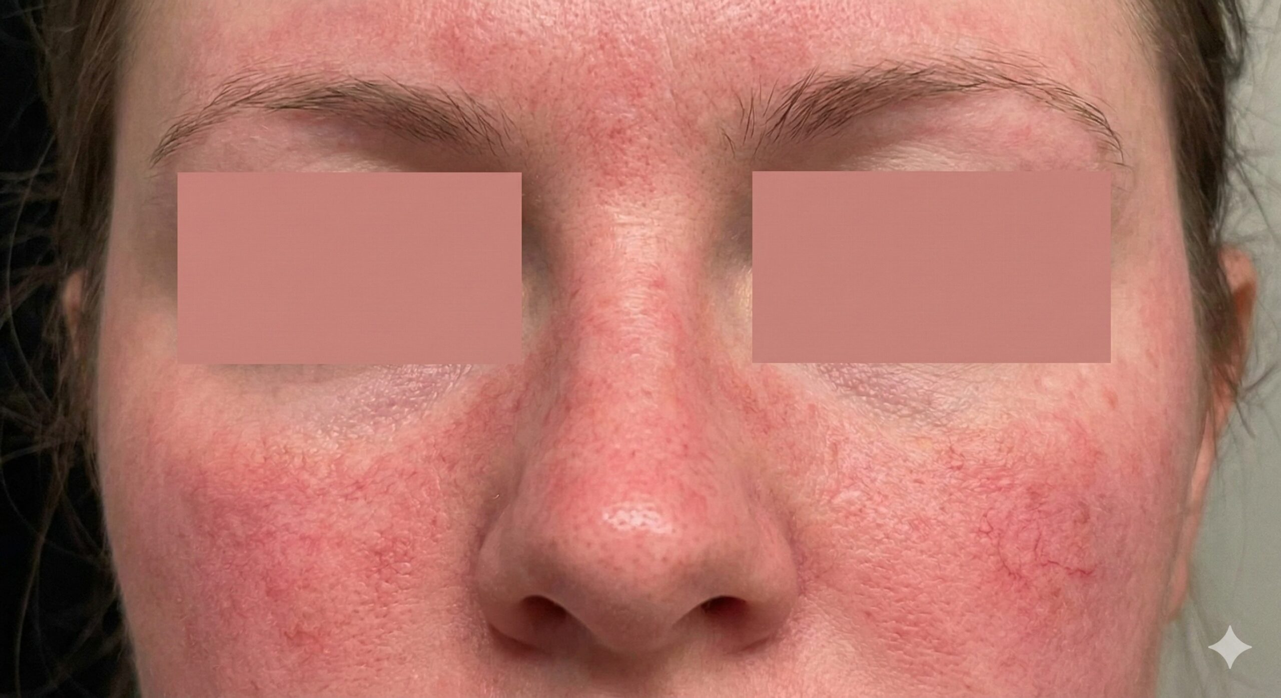 Rosacea - TheFrugalDerm.com Rosacea - TheFrugalDerm.com