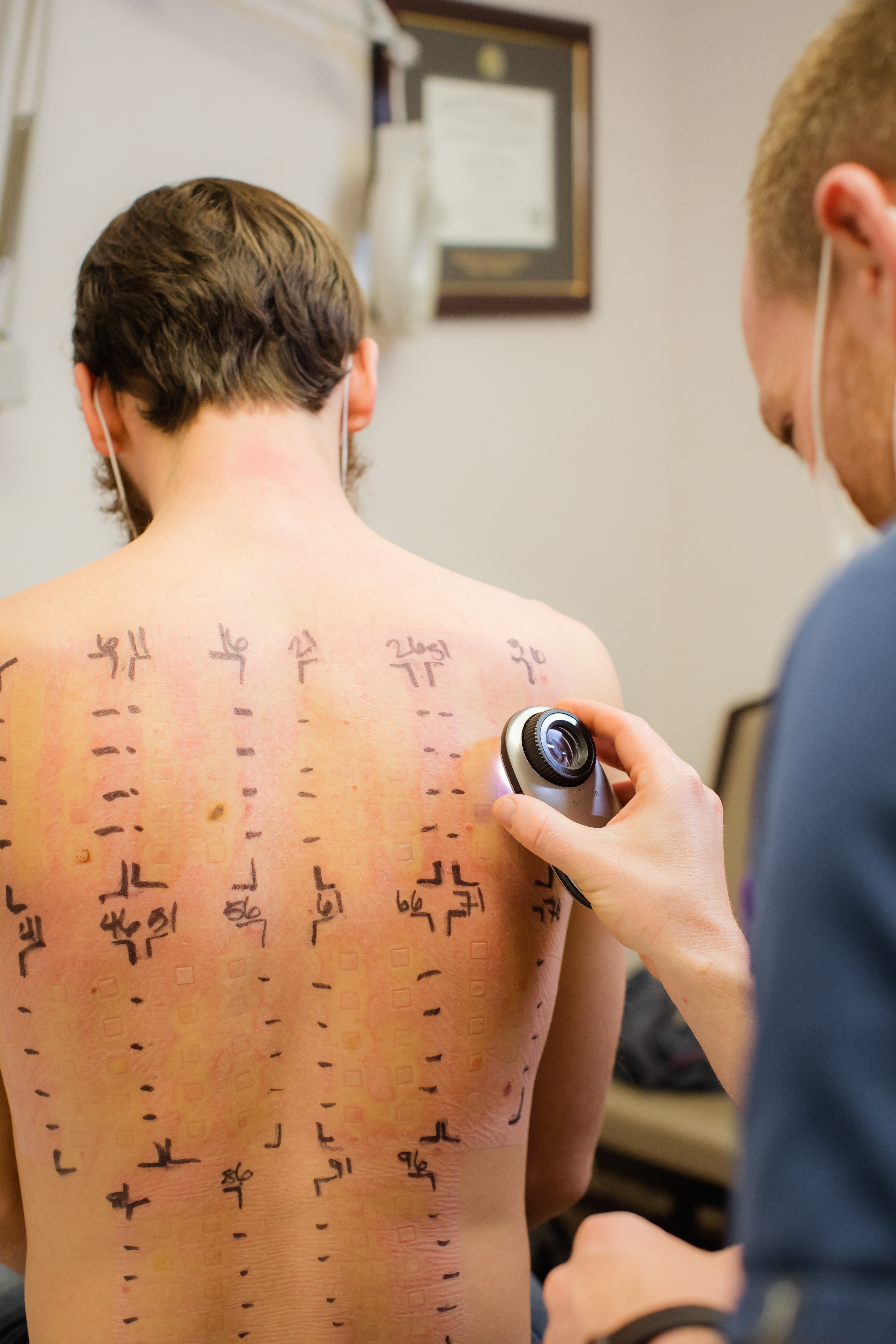 Patch testing on back for allergic contact dermatitis in Layton Utah