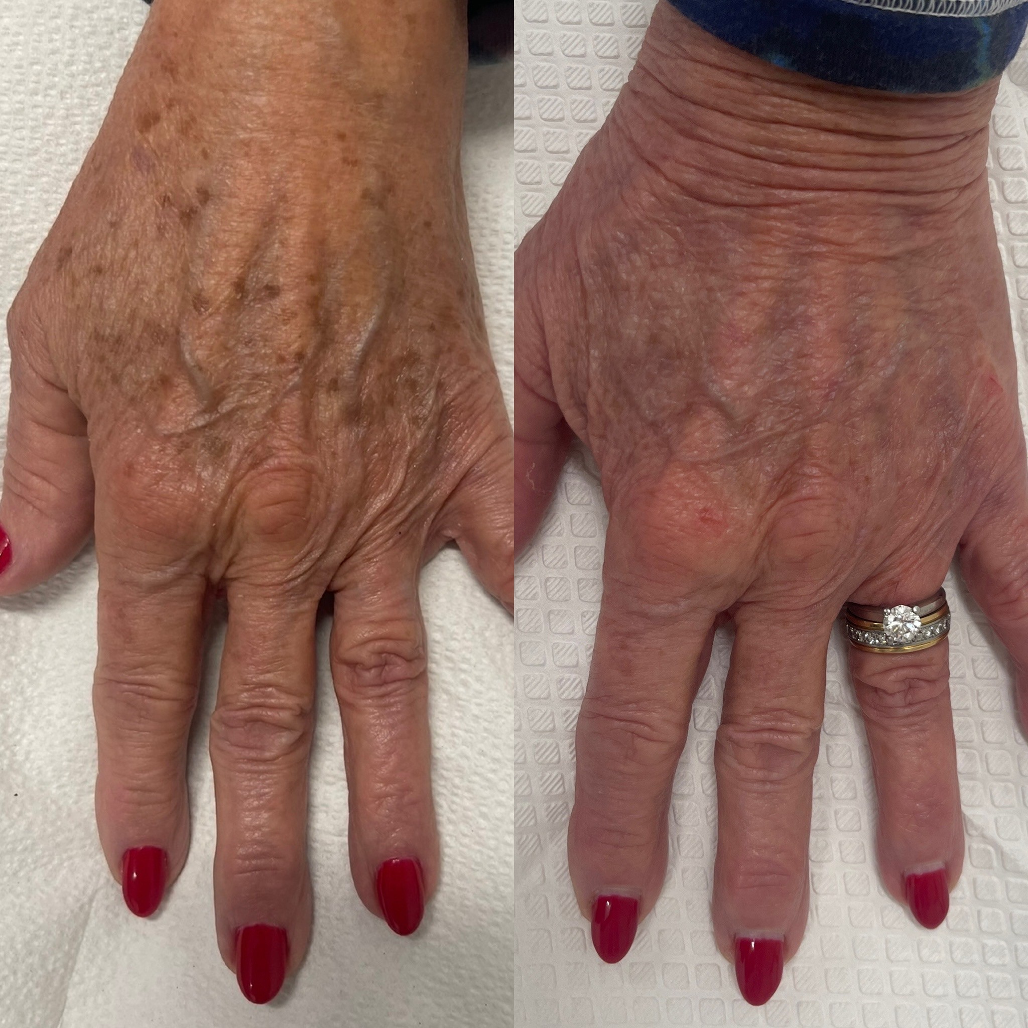 Before and after photos of IPL for sun spots on the top of the hands.