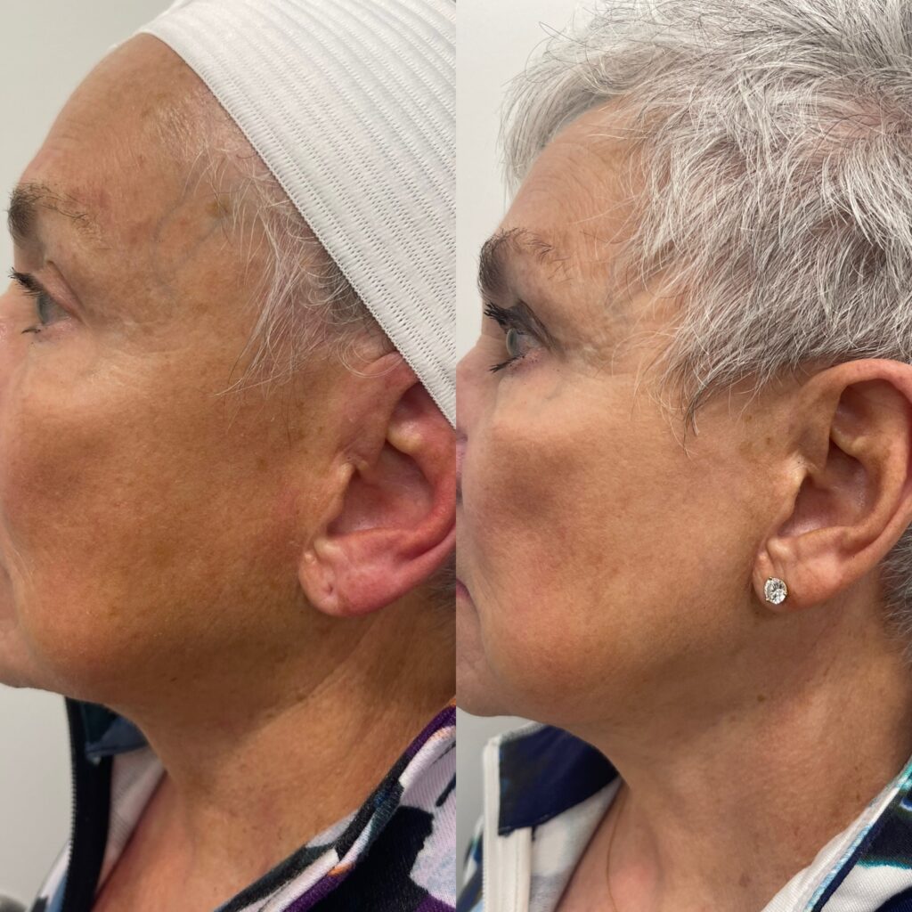 Before and after photos of a woman who did an IPL treatment to remove sun damage and sun spots from face, neck, and chest. Side profile.