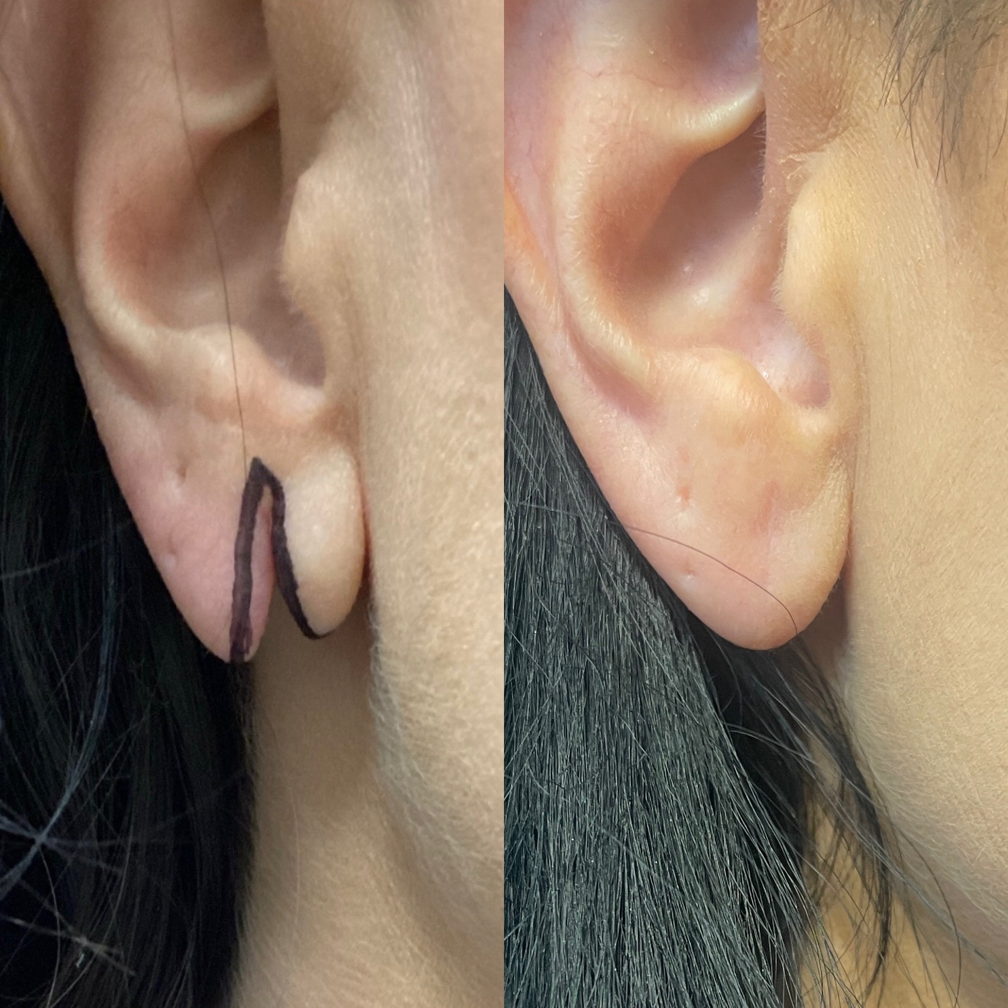 Before and after split ear lobe repair by Dr. Matthew Innes in Layton, Utah