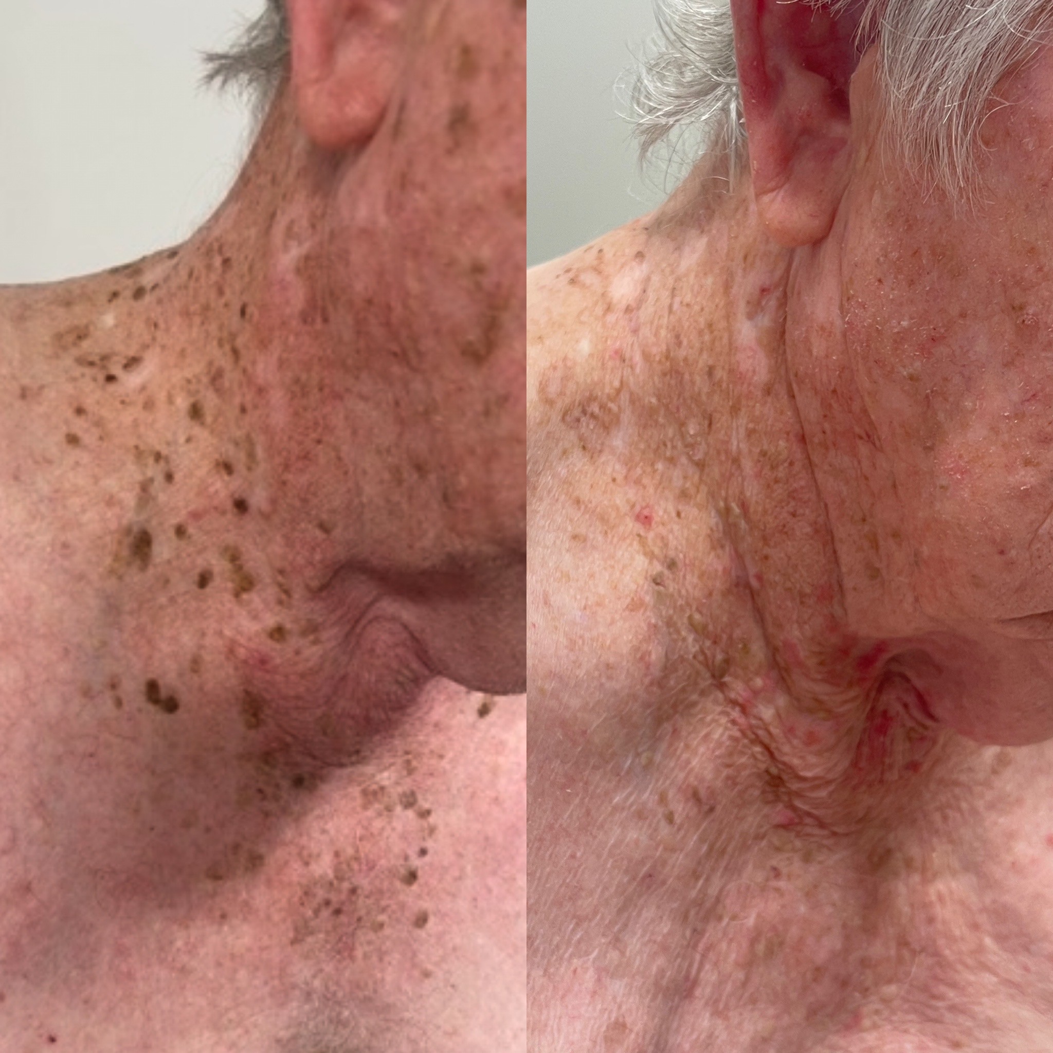 Before and after removal of seborrheic keratoses (SKs) on the neck and back with laser ablation by Dr. Matthew Innes in Layton, Utah.