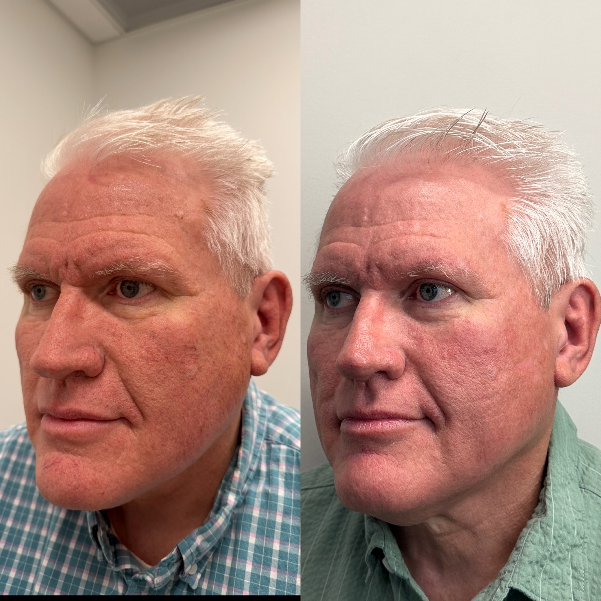 Before and after comparison of IPL laser treatment for rosacea redness, showing a singificant reduction in visible blood vessels and facial redness.